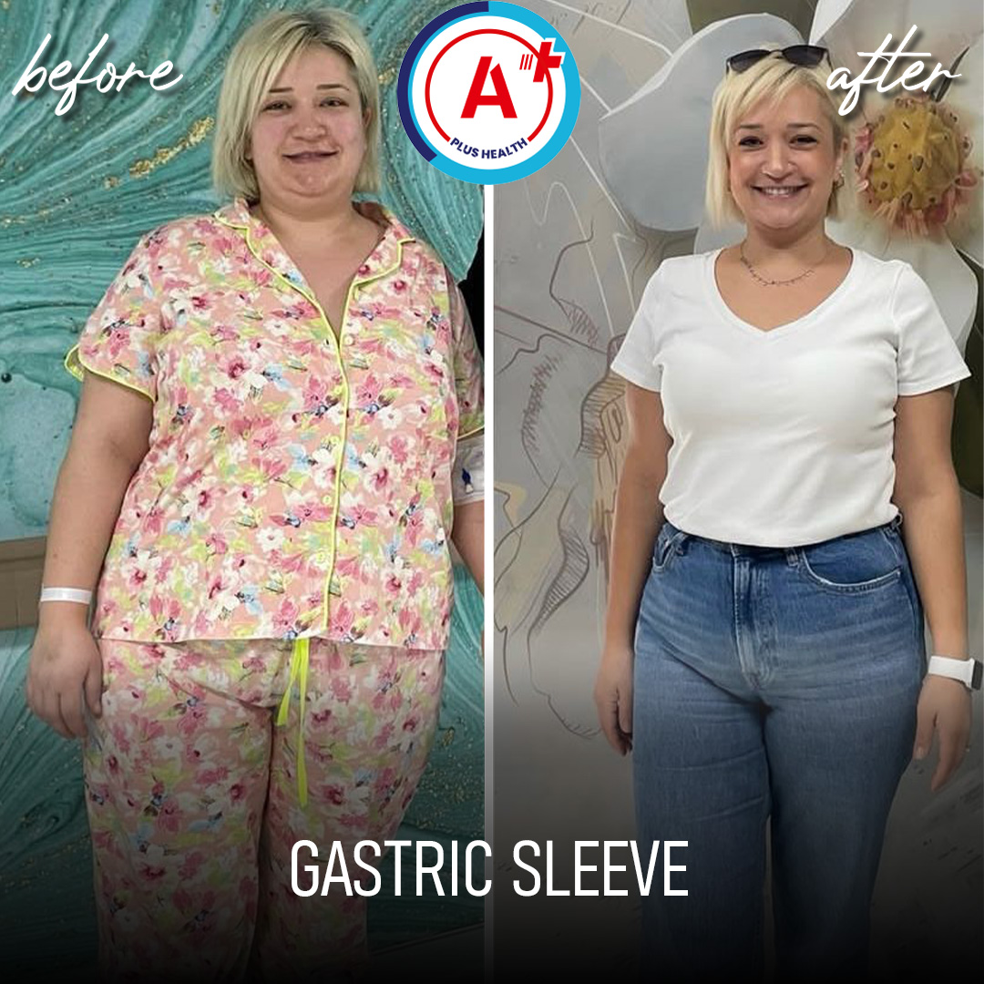 Gastric Sleeve Before & After