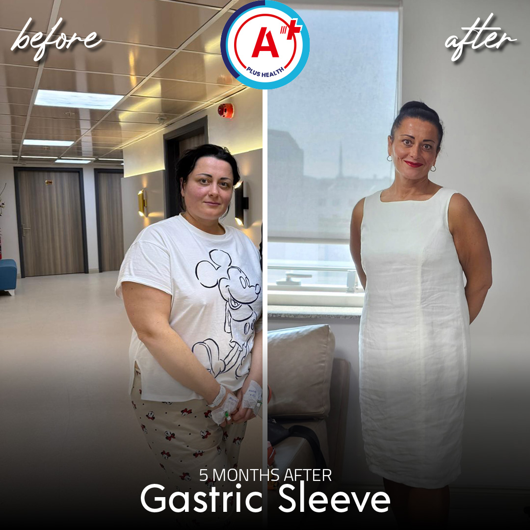 Gastric Sleeve 5 Months After