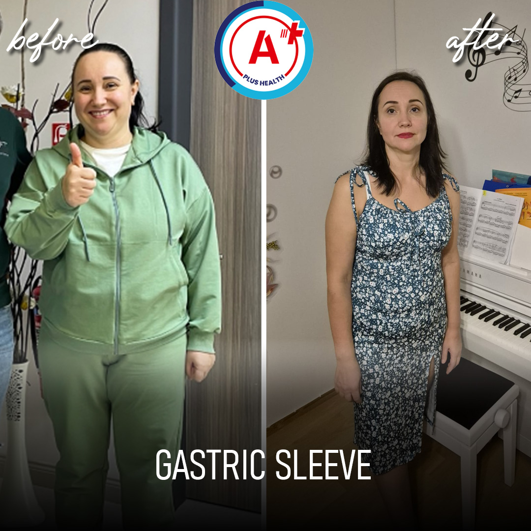 Gastric Sleeve