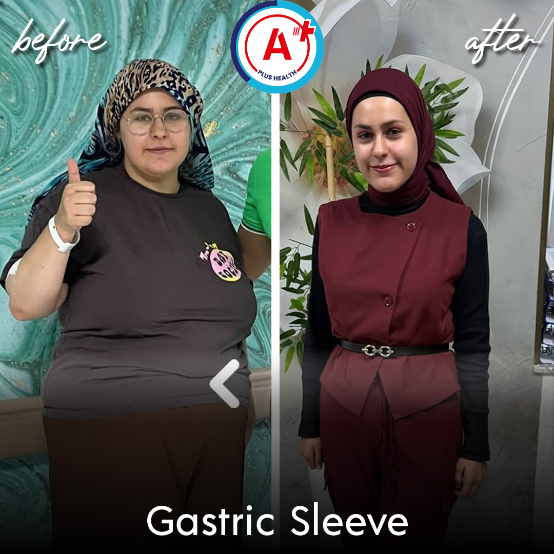 Gastric Sleeve Before & After