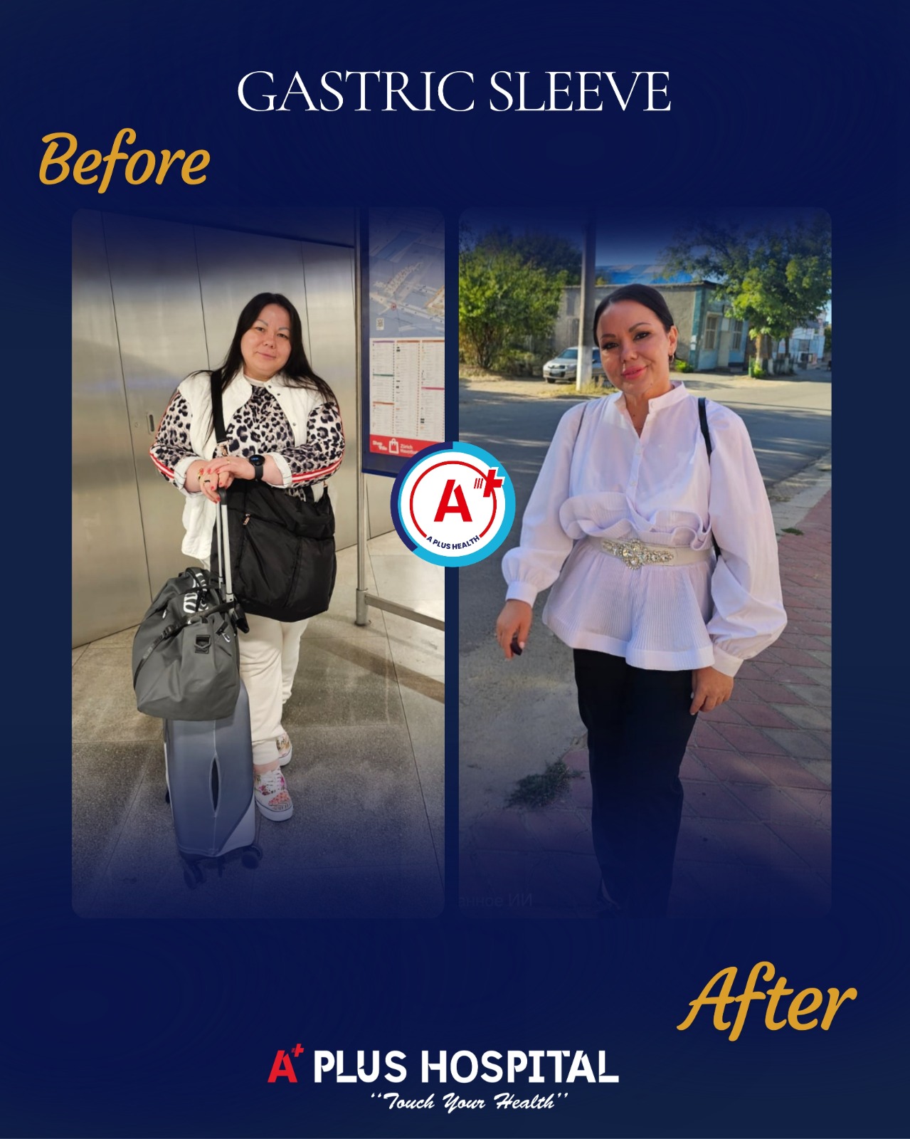 Gastric Sleeve Before & After