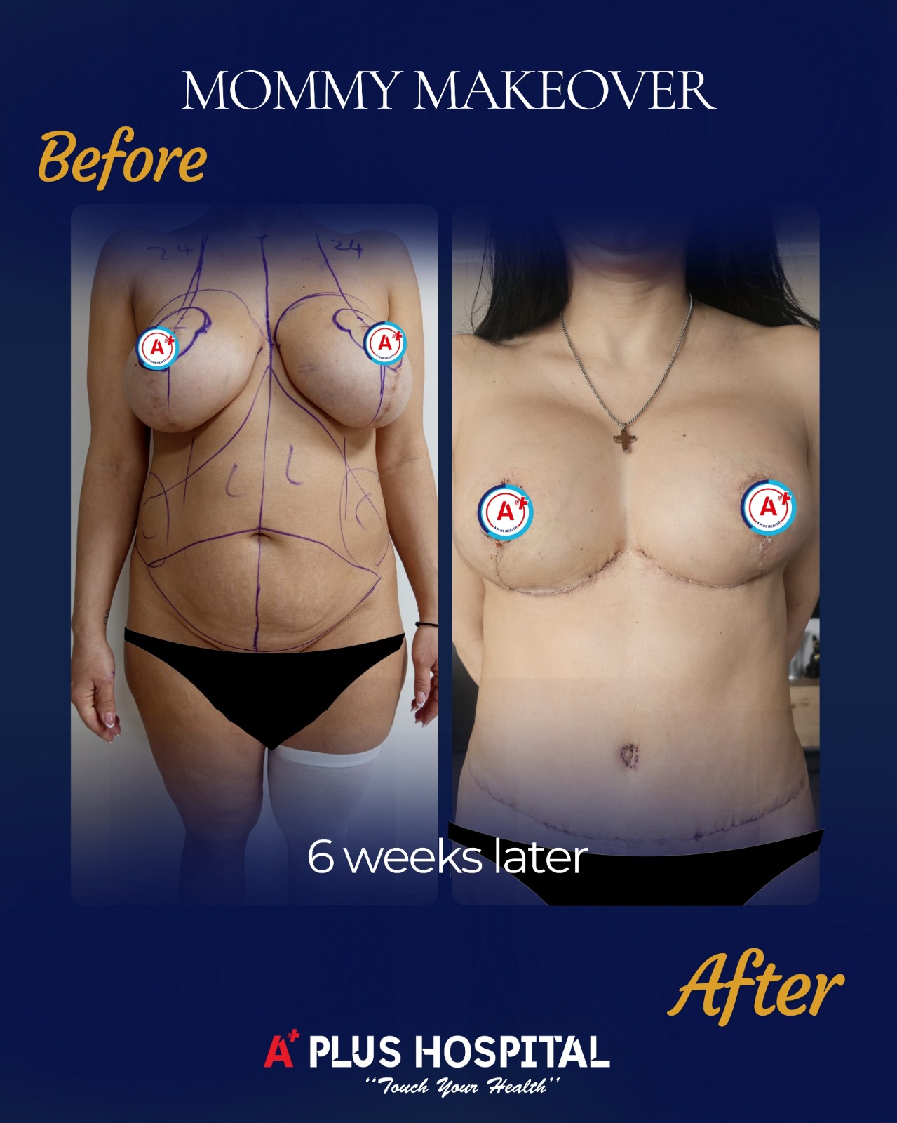 Mommy Makeover Before & After