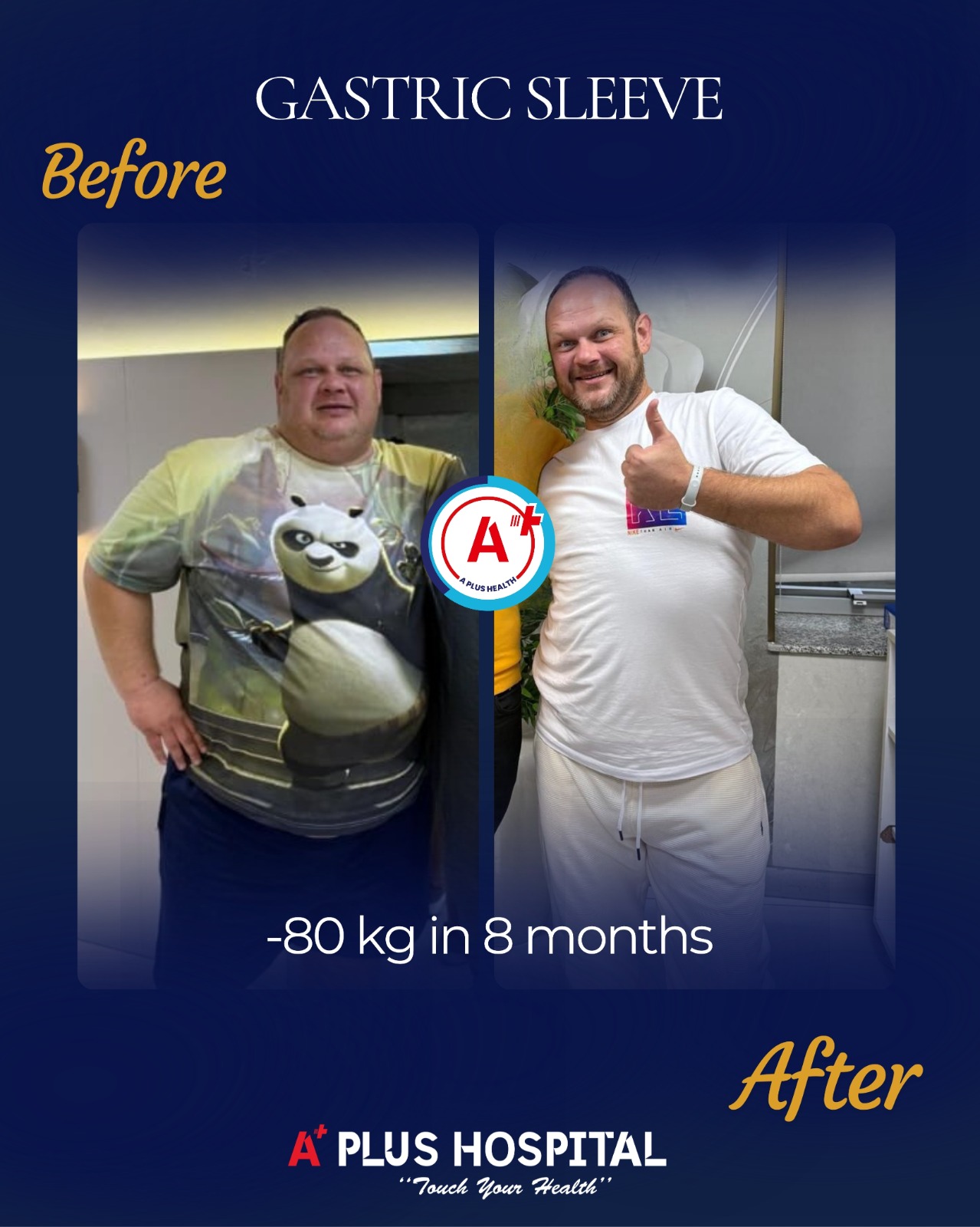 Gastric Sleeve -80kg Before & After